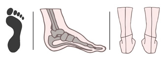 Fußfehlstellungen - Normaler Fuß